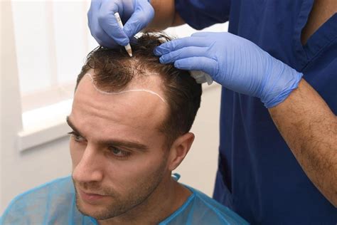 best hair transplant clinics turkey.